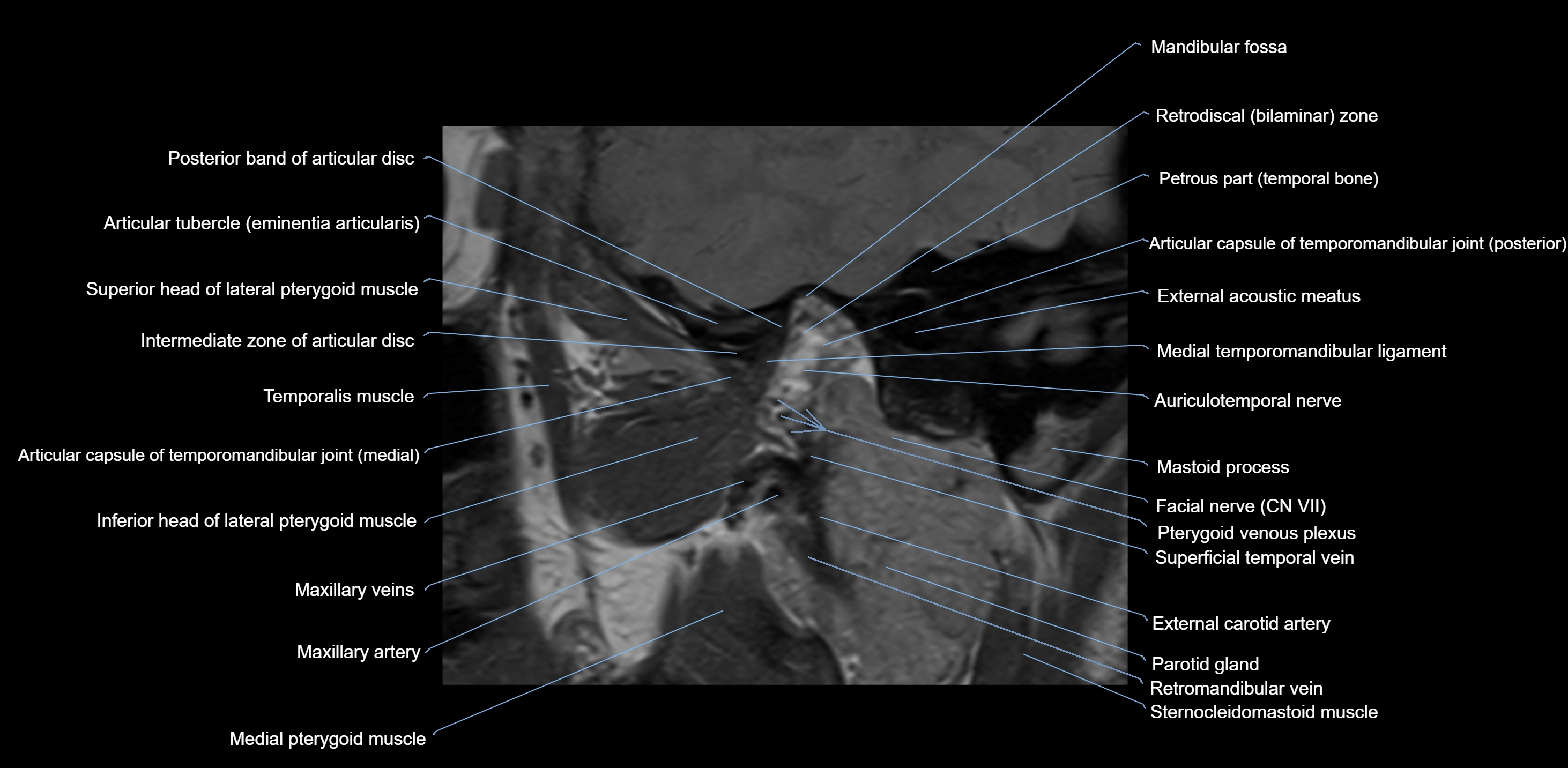 MRI TMJ sagittal open  mouth cross sectional 3T anatomy -img-00001-00010.webp